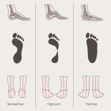 chart of a normal foot, a high arch foot, and a low arch foot